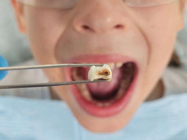 Best Chipped Tooth Repair Near Me  in Newport, RI